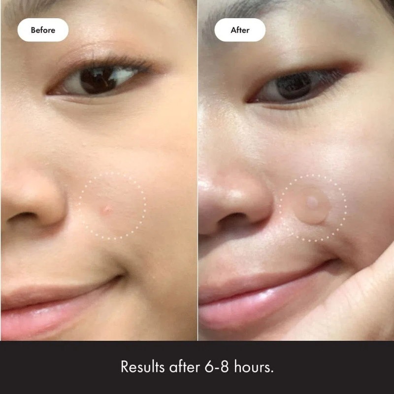 🔥New Arrival 50%OFF💥Hydrocolloid acne patch that shrinks pimples and whiteheads with a single use