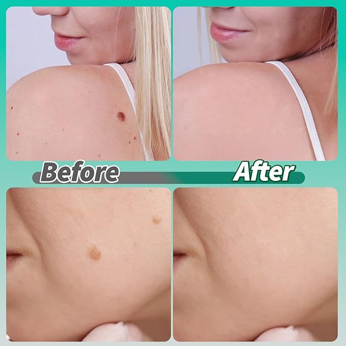🌈 LAST DAY SALE-50% OFF 🔥Wart removal patch, strong skin care removal patch - 144 pieces