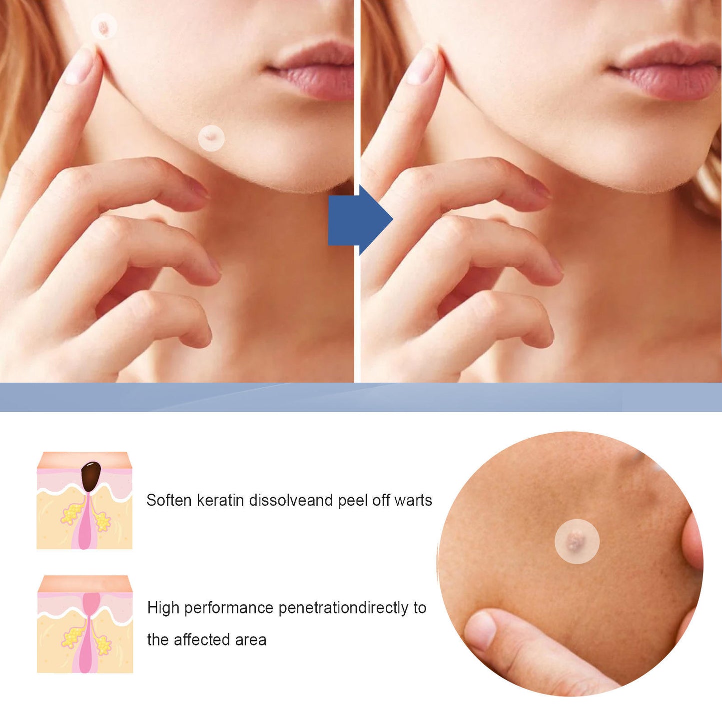 🌈 LAST DAY SALE-50% OFF 🔥Wart removal patch, strong skin care removal patch - 144 pieces