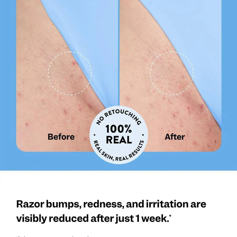 🔥 50% OFF 🔥Smoothing Solution Ingrown Hair Treatment: Glide Your Way to Silky-Smooth, Bump-Free Skin
