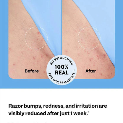 🔥 50% OFF 🔥Smoothing Solution Ingrown Hair Treatment: Glide Your Way to Silky-Smooth, Bump-Free Skin